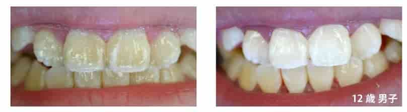 口コミ比較】ポリリンEXの効果は？どのくらい歯が白くなるの？ポリリン酸デンタルまとめ